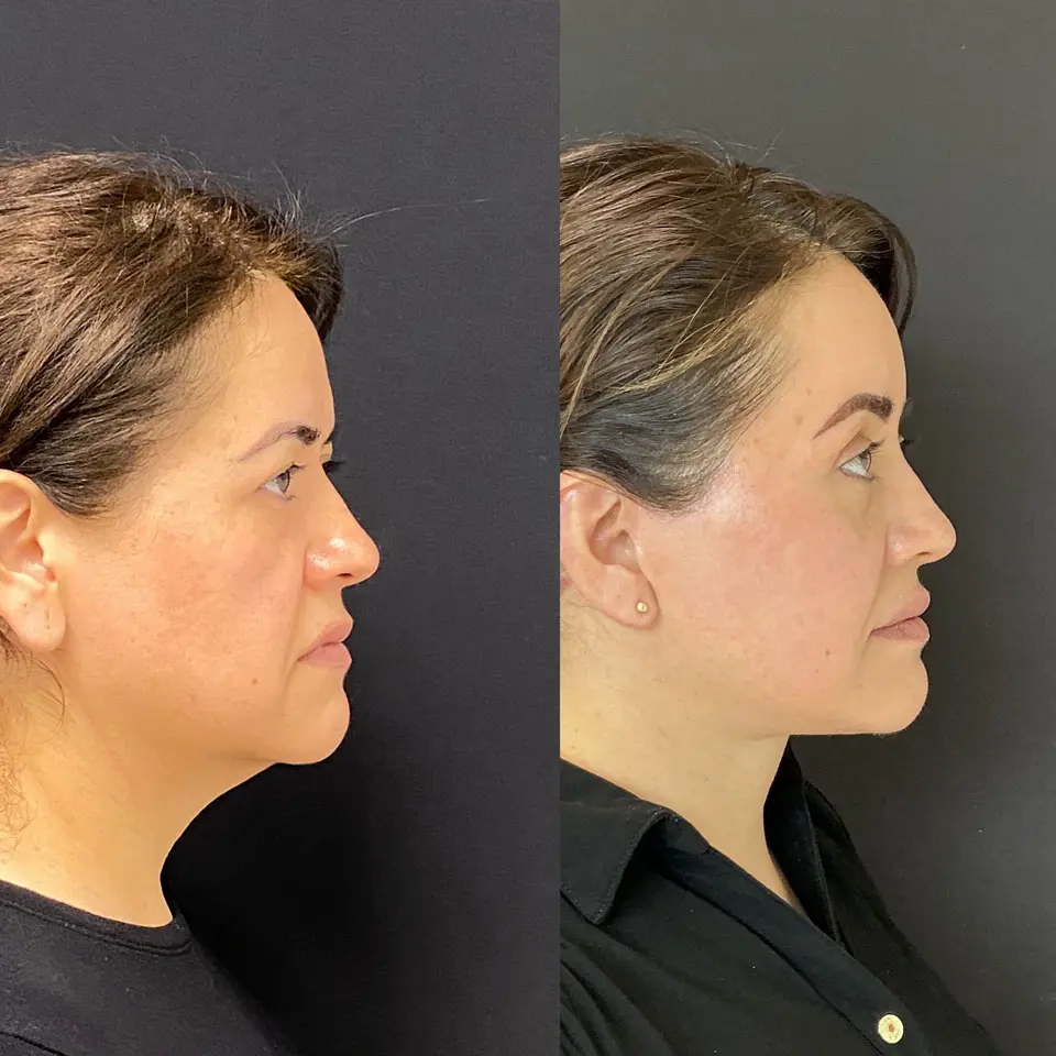 Eyelid Lift Before and After Patient 4