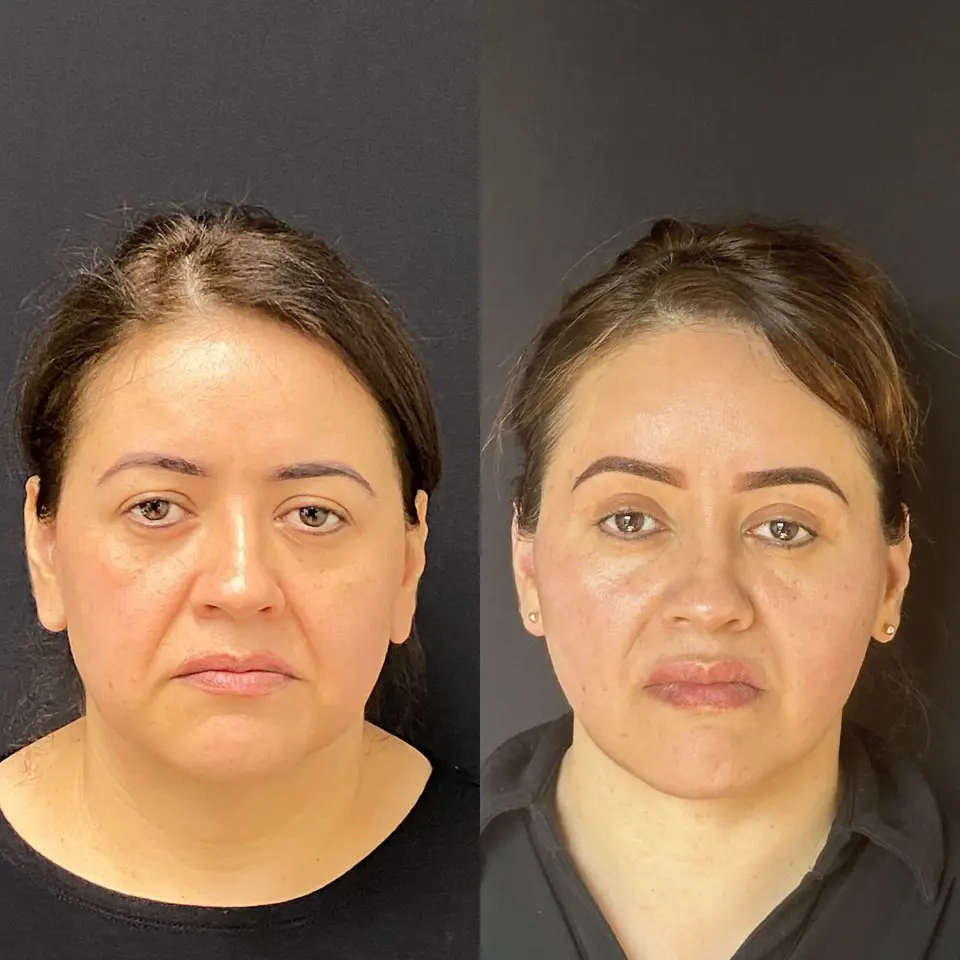 Eyelid Lift Before and After Patient 1
