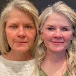 Eyelid Lift Before and After Patient Thumbnail 1