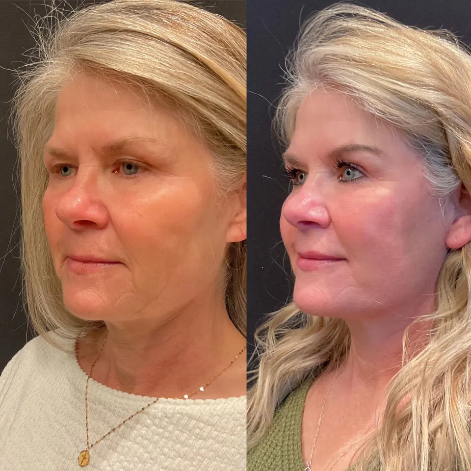 Eyelid Lift Before and After Patient 4
