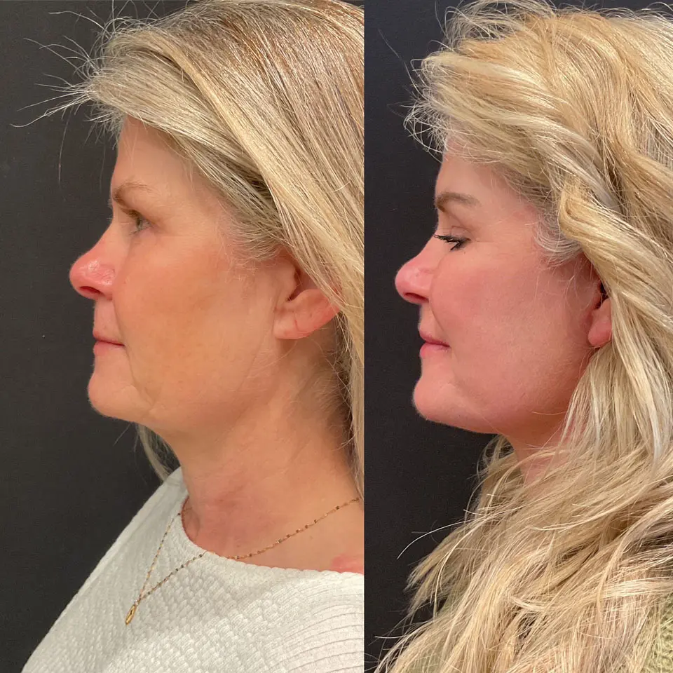 Eyelid Lift Before and After Patient 3