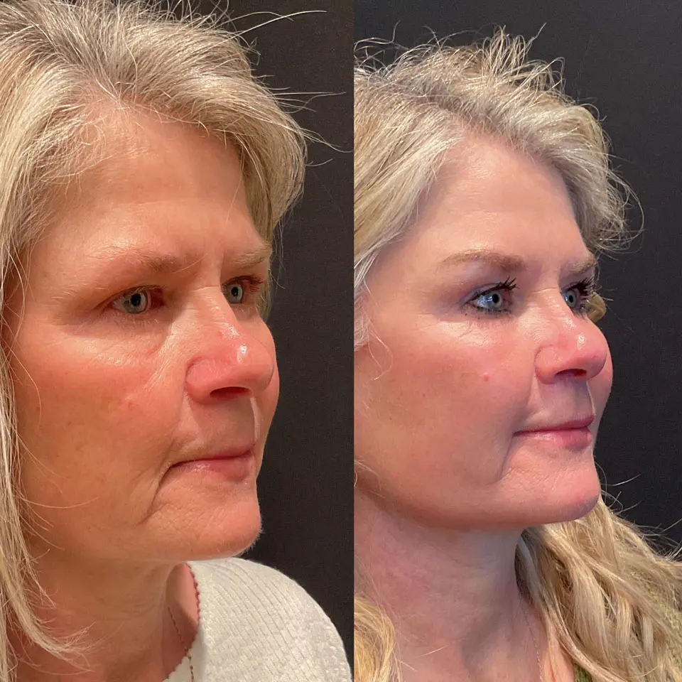 Eyelid Lift Before and After Patient 2