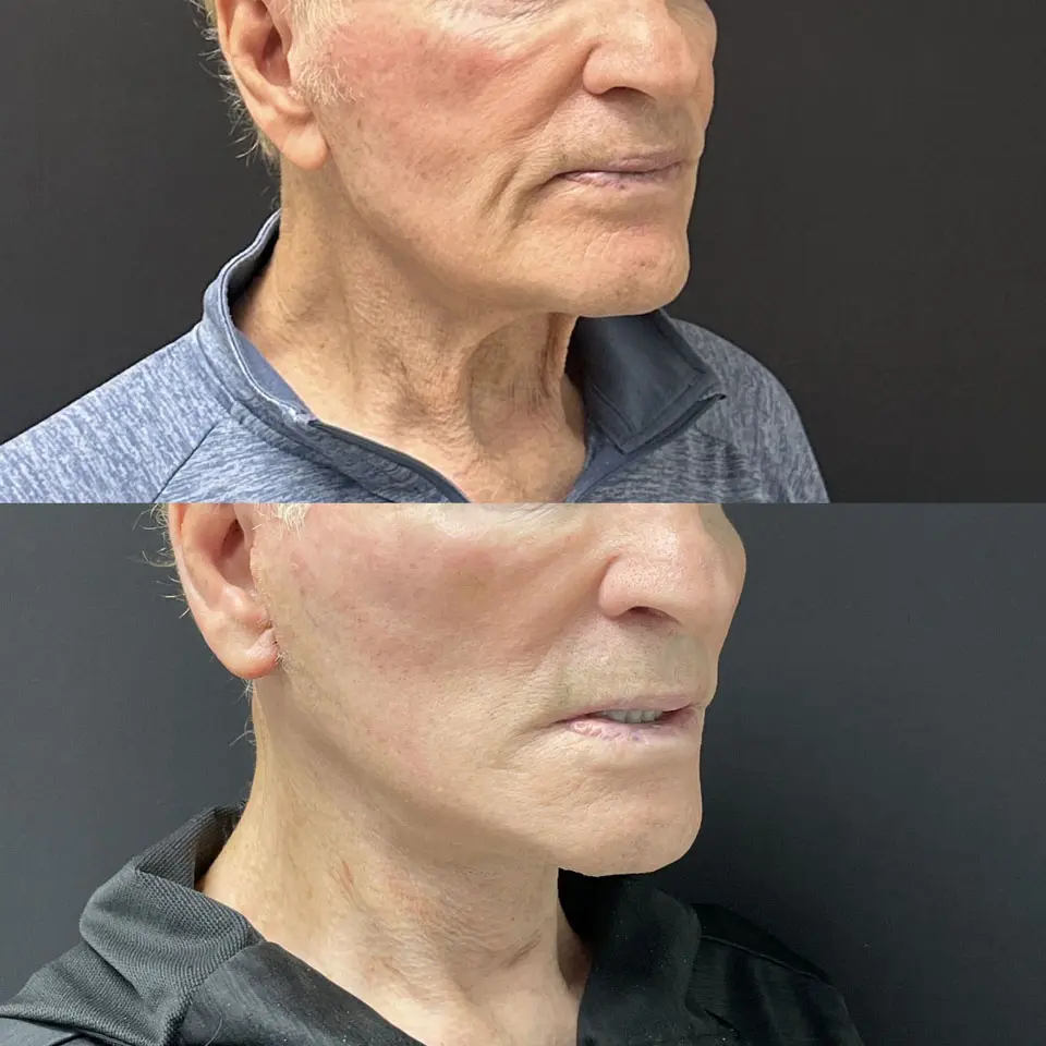 Facelift & Neck Lift Before and After Patient 3