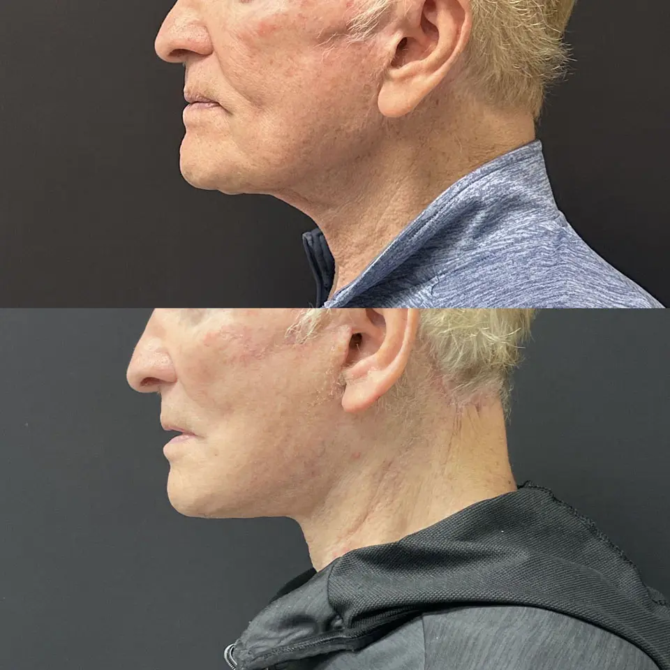 Facelift & Neck Lift Before and After Patient 2