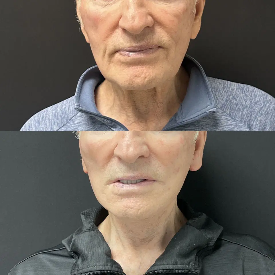 Facelift & Neck Lift Before and After Patient 1