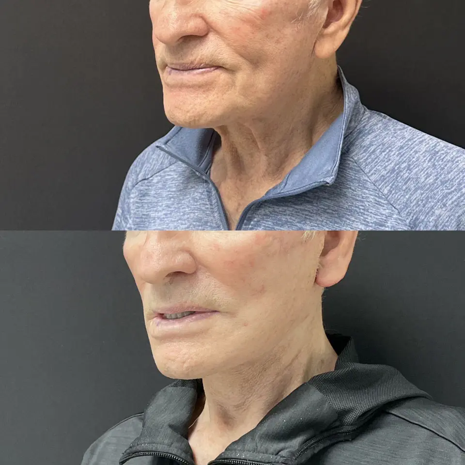 Facelift & Neck Lift Before and After Patient 4
