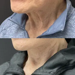 Facelift & Neck Lift Before and After Patient Thumbnail 5