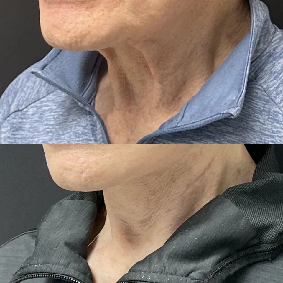 Facelift & Neck Lift Before and After Patient 5