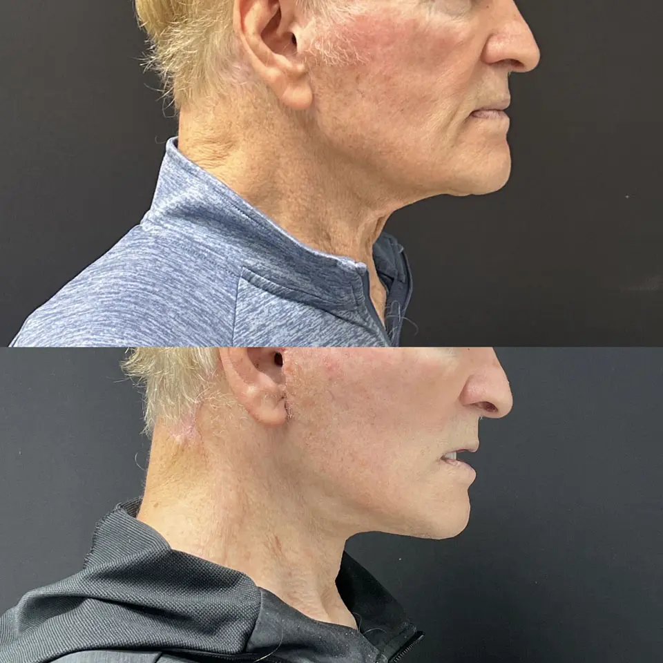 Facelift & Neck Lift Before and After Patient 6