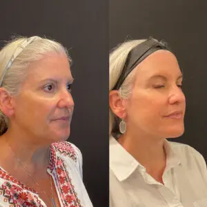 Eyelid Lift Before and After Patient Thumbnail 5