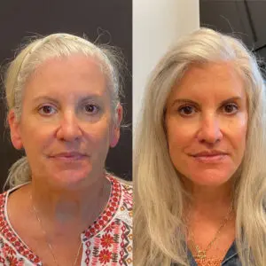Eyelid Lift Before and After Patient Thumbnail 1