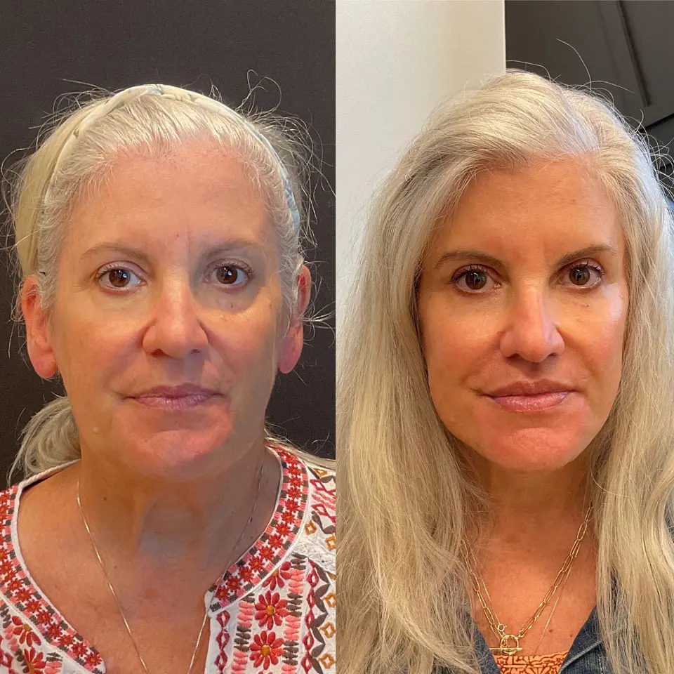 Eyelid Lift Before and After Patient 1