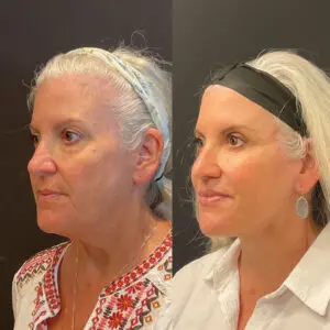 Eyelid Lift Before and After Patient Thumbnail 4
