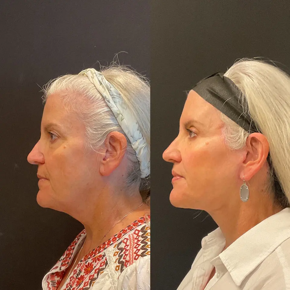 Eyelid Lift Before and After Patient 2