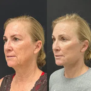Facelift & Neck Lift Before and After Patient Thumbnail 5