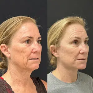 Facelift & Neck Lift Before and After Patient Thumbnail 4