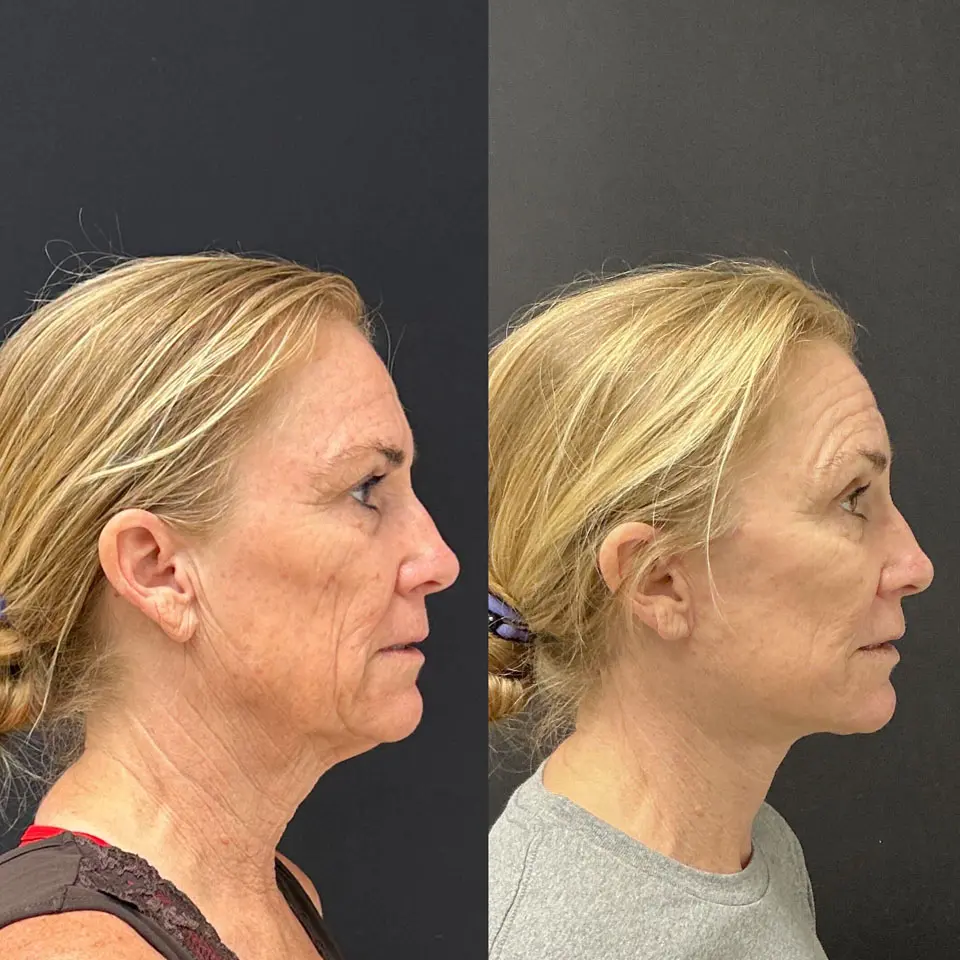 Facelift & Neck Lift Before and After Patient 3