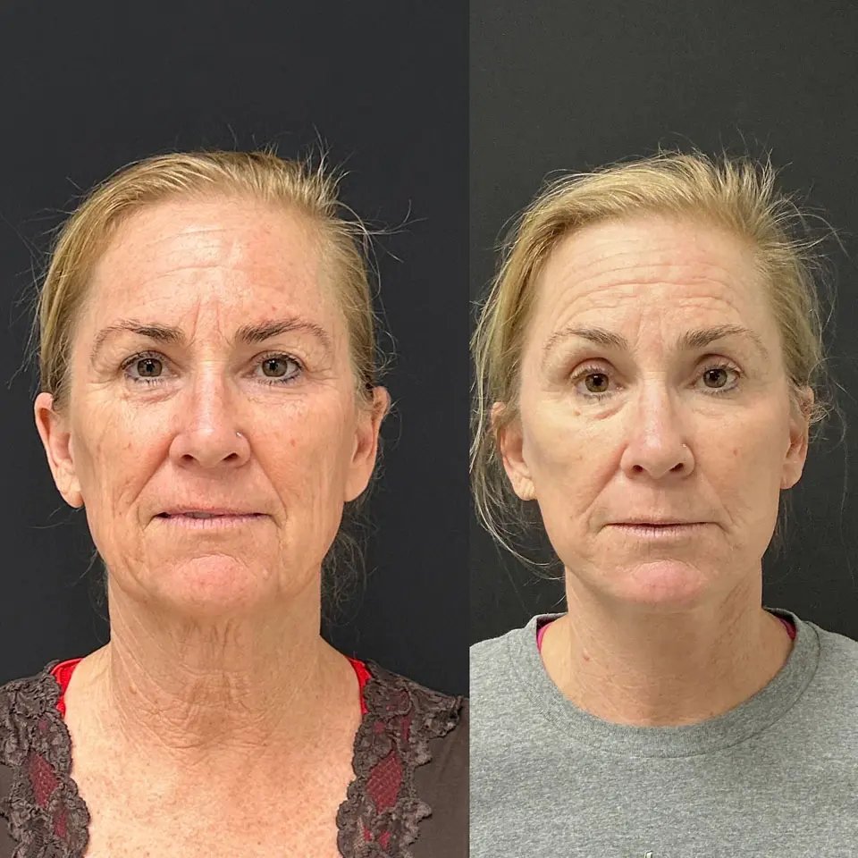 Facelift & Neck Lift Before and After Patient 1