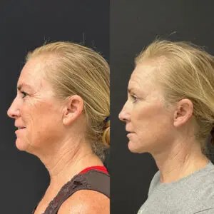 Facelift & Neck Lift Before and After Patient Thumbnail 2