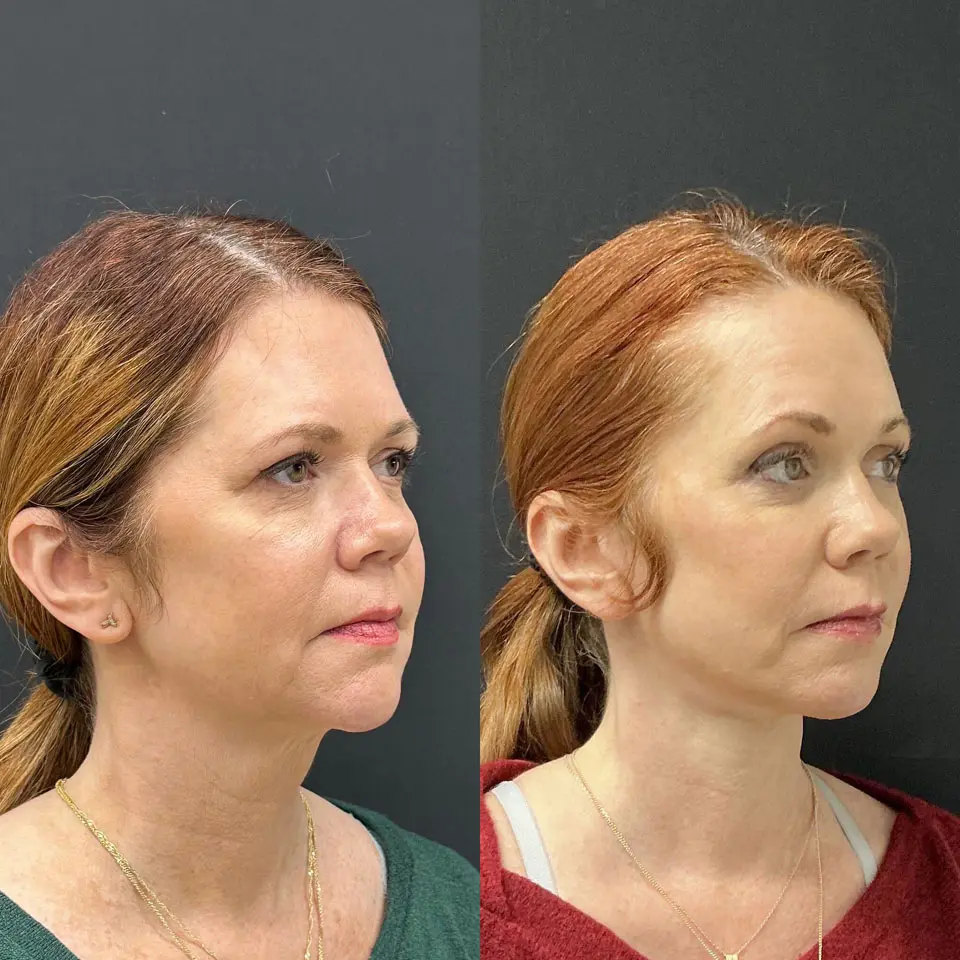 Eyelid Lift Before and After Patient 3