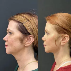 Eyelid Lift Before and After Patient Thumbnail 4