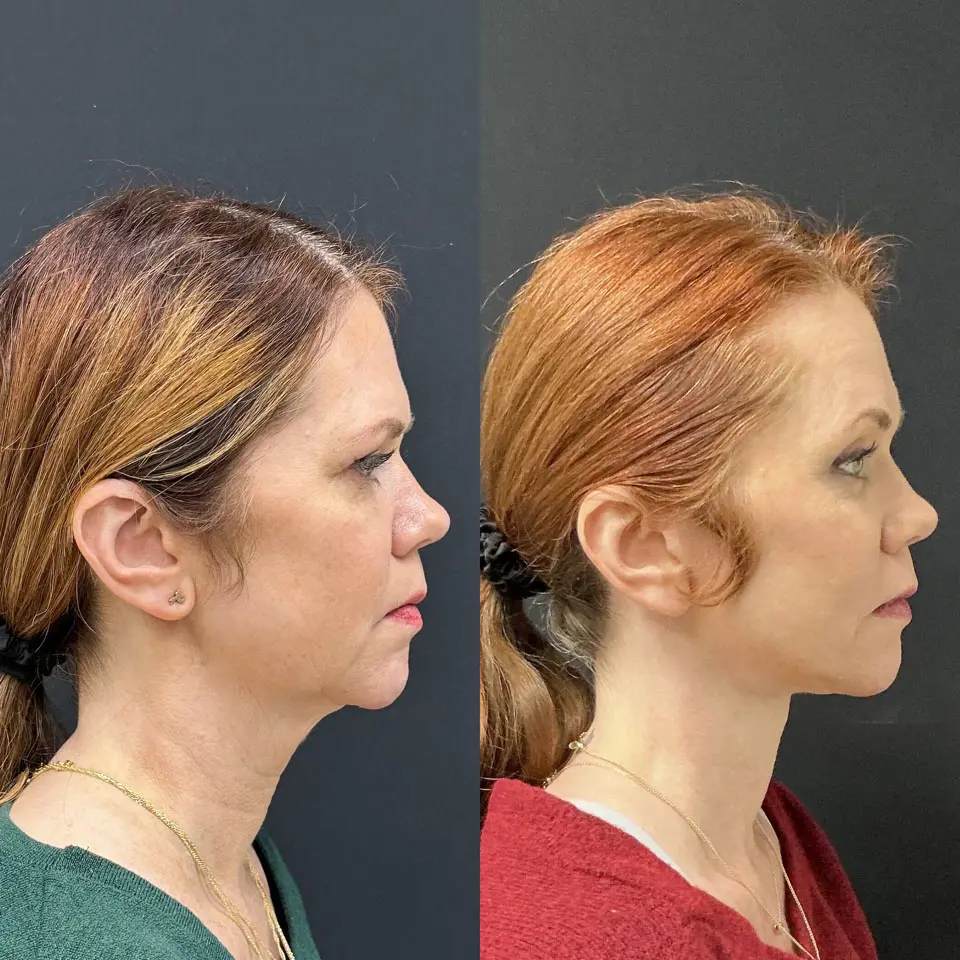 Eyelid Lift Before and After Patient 5