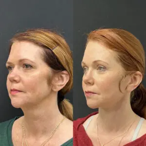 Eyelid Lift Before and After Patient Thumbnail 2