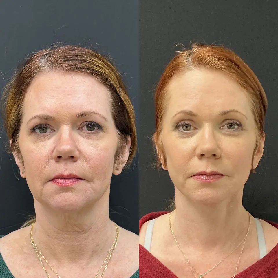 Eyelid Lift Before and After Patient 1