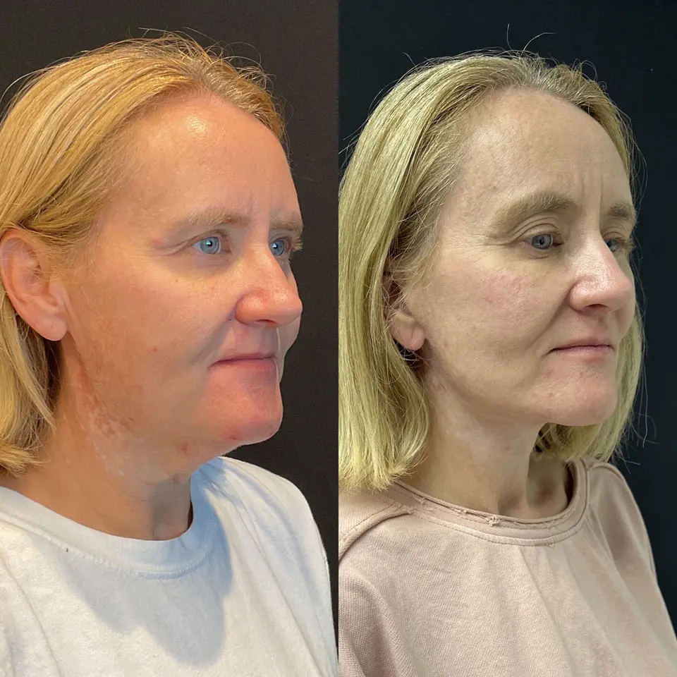 Facelift & Neck Lift Before and After Patient 3