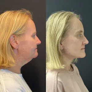 Facelift & Neck Lift Before and After Patient Thumbnail 4