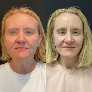 Facelift & Neck Lift Before and After Patient Thumbnail 1