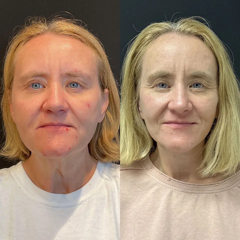 Facelift & Neck Lift Before and After Patient 1