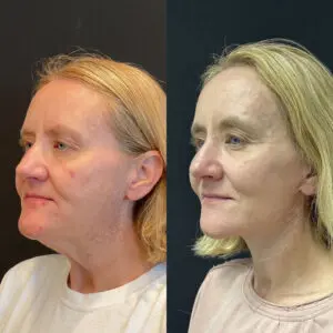 Facelift & Neck Lift Before and After Patient Thumbnail 2