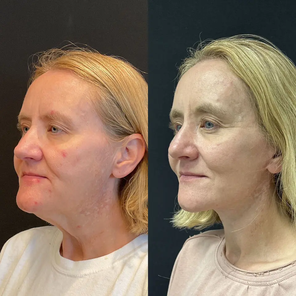 Facelift & Neck Lift Before and After Patient 2