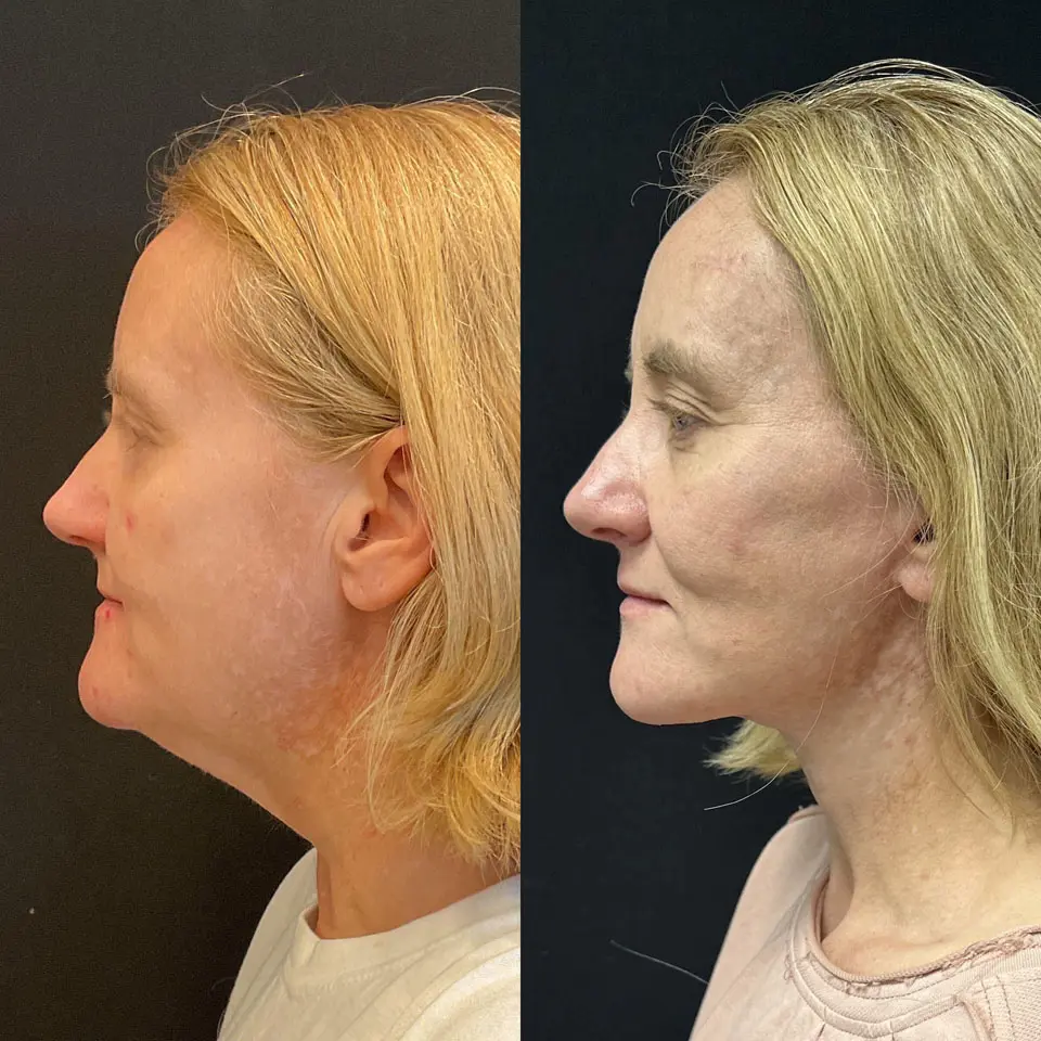 Facelift & Neck Lift Before and After Patient 5