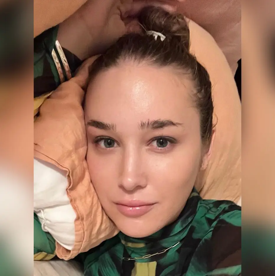 Facial Feminization Before and After Patient 3