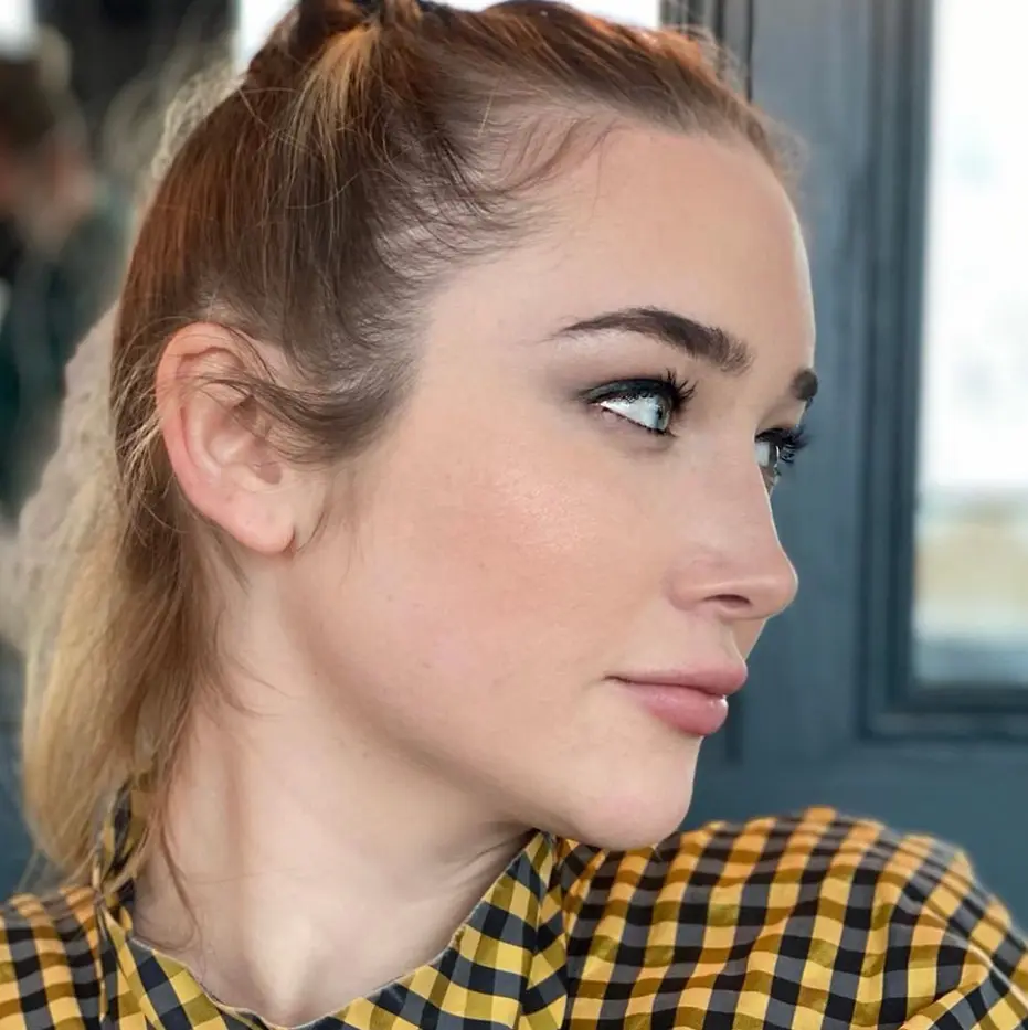 Facial Feminization Before and After Patient 2