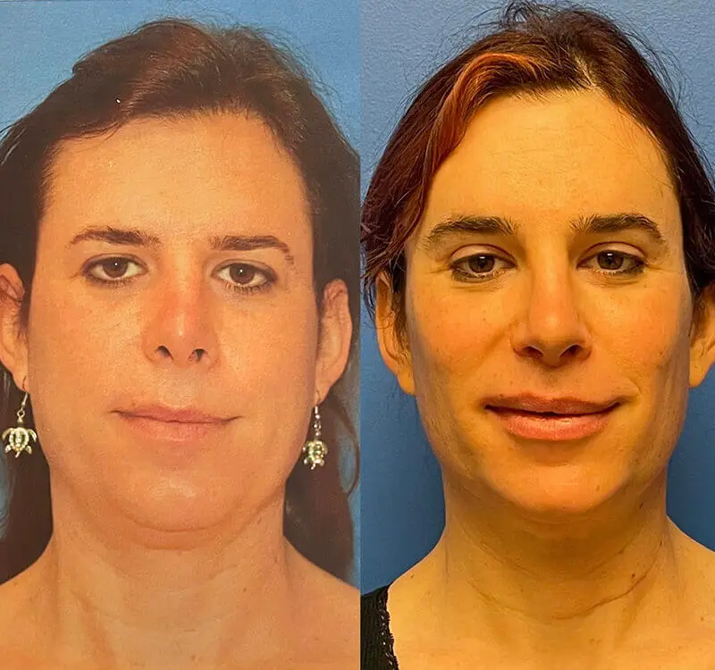 Facial Feminization Before and After Patient 1