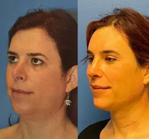 Facial Feminization Before and After Patient Thumbnail 2