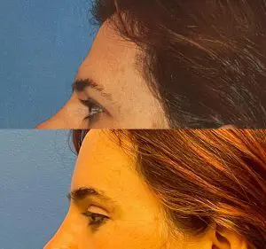 Facial Feminization Before and After Patient Thumbnail 3