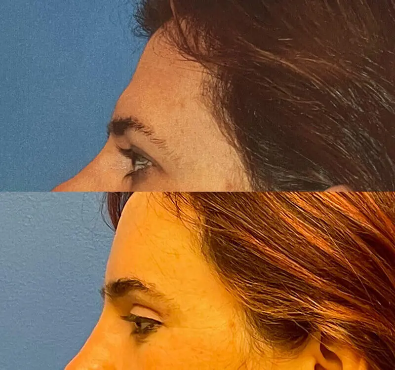 Facial Feminization Before and After Patient 3