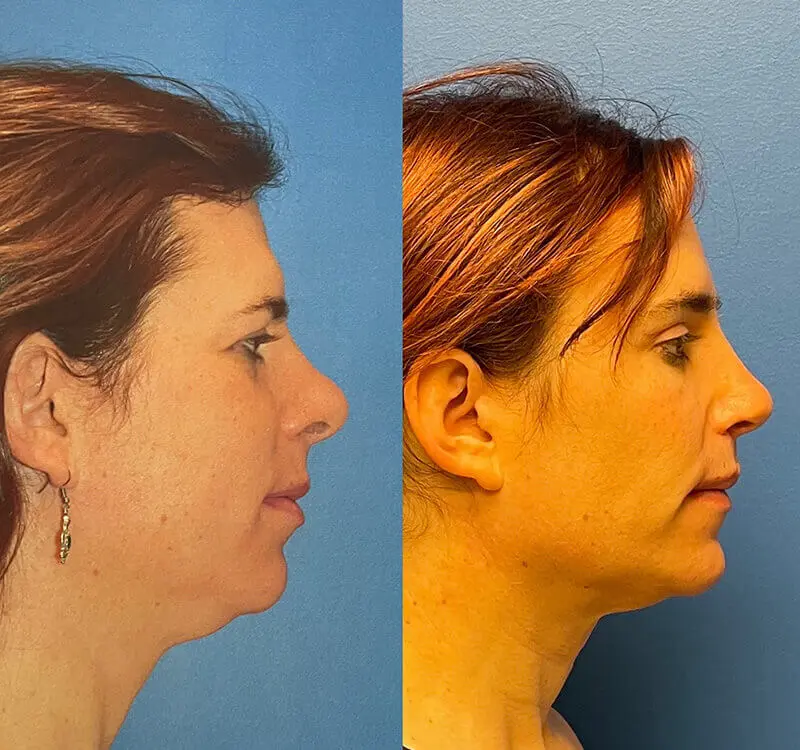 Facial Feminization Before and After Patient 4