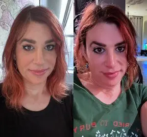 Facial Feminization Before and After Patient Thumbnail 5