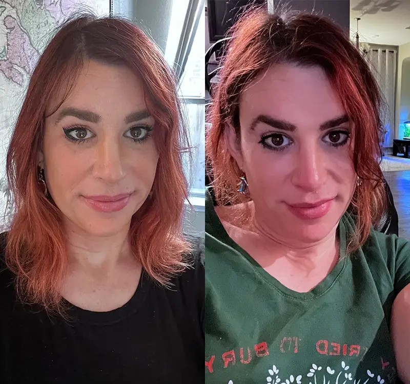 Facial Feminization Before and After Patient 5