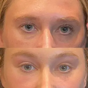 Facial Rejuvenation Before and After Patient Thumbnail 1