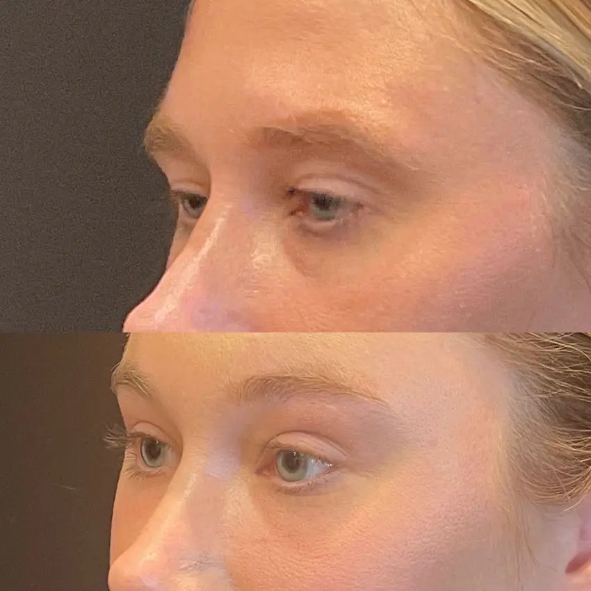 Facial Rejuvenation Before and After Patient 3