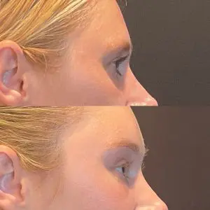 Facial Rejuvenation Before and After Patient Thumbnail 4