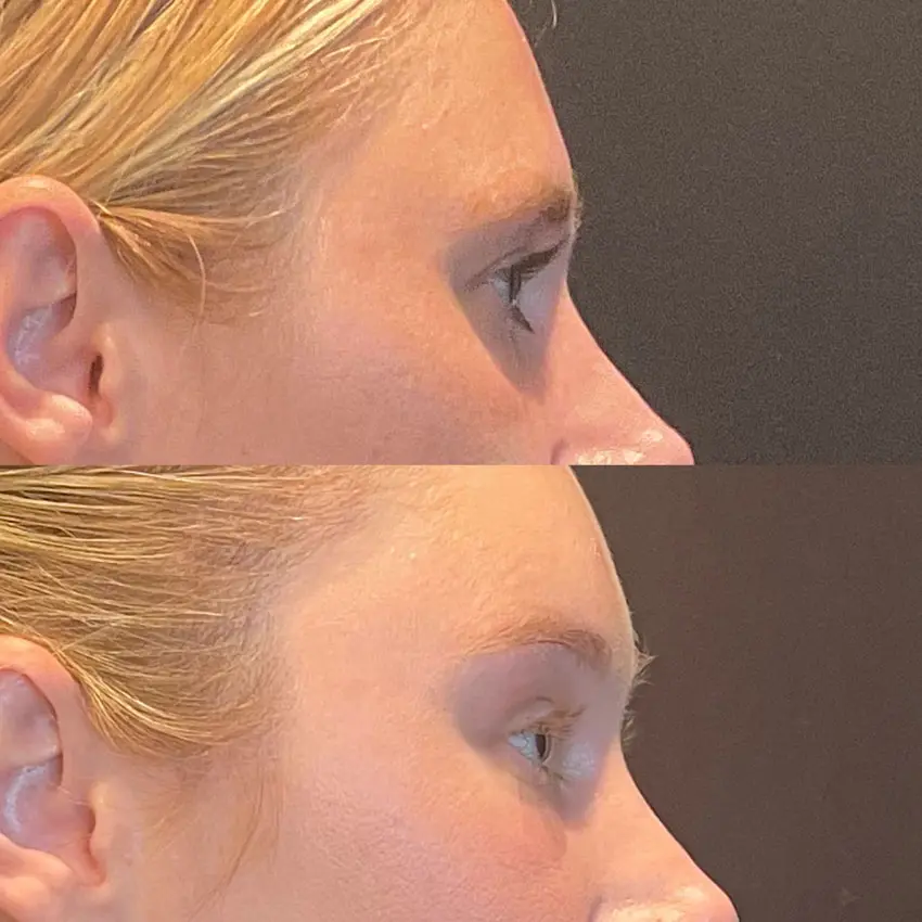 Facial Rejuvenation Before and After Patient 4