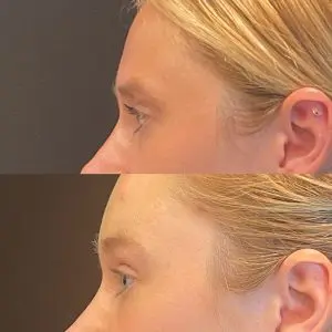 Facial Rejuvenation Before and After Patient Thumbnail 5