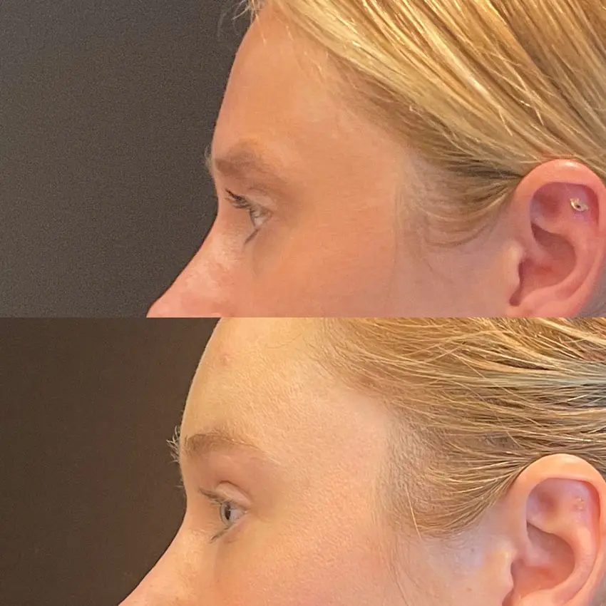 Facial Rejuvenation Before and After Patient 5